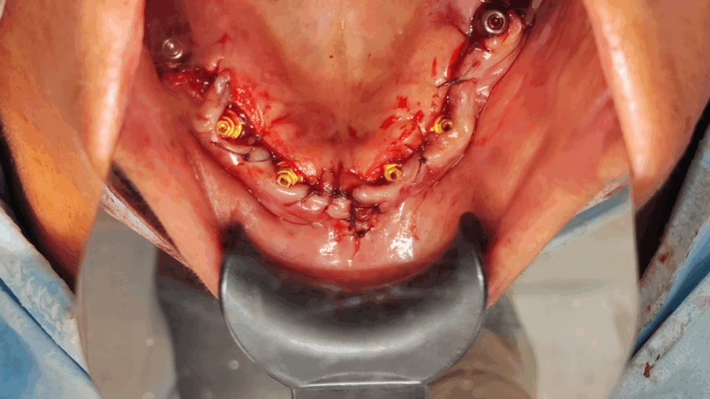 Caso Clínico - Cirugía