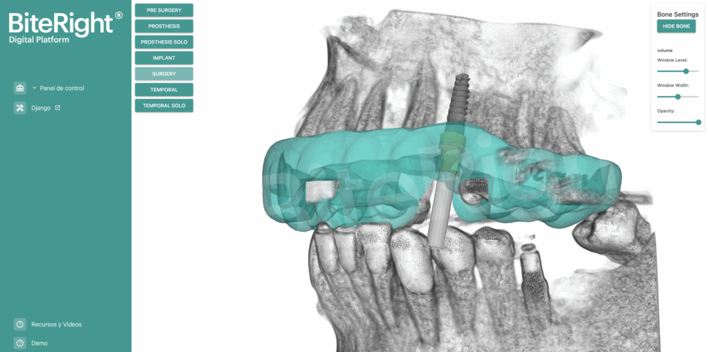Implantología digital de alta precisión: visor 3D con hueso en BiteRight Digital Platform.