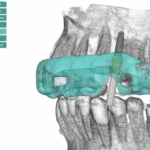Implantología digital de alta precisión: visor 3D con hueso en BiteRight Digital Platform.